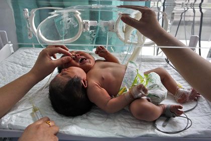 โถ๋ลูกแม่! ทารกแฝดจีนเกิดมาผิดปกติ "มี 2 หัวในร่างเดียว"