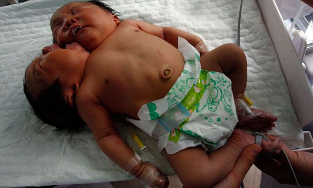 โถ๋ลูกแม่! ทารกแฝดจีนเกิดมาผิดปกติ "มี 2 หัวในร่างเดียว"