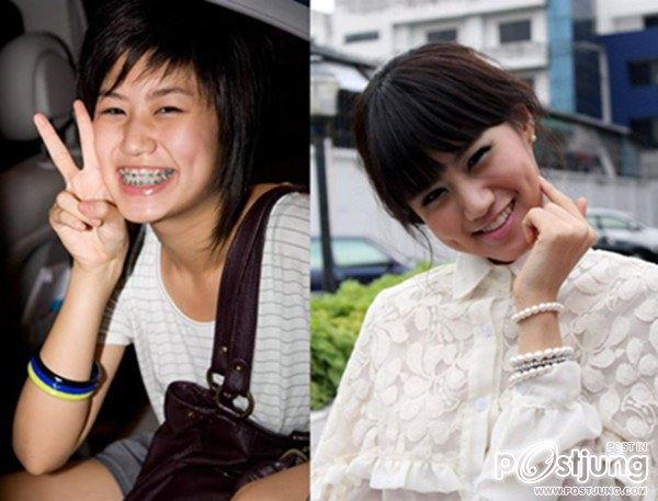 สาวๆก่อนและหลังดัดฟัน