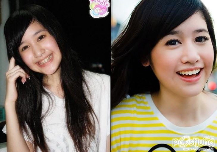 สาวๆก่อนและหลังดัดฟัน