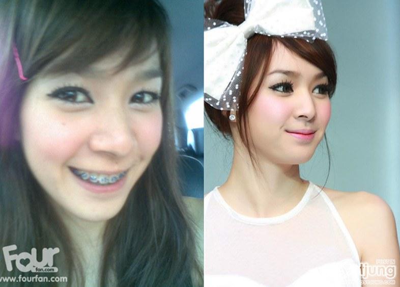 สาวๆก่อนและหลังดัดฟัน