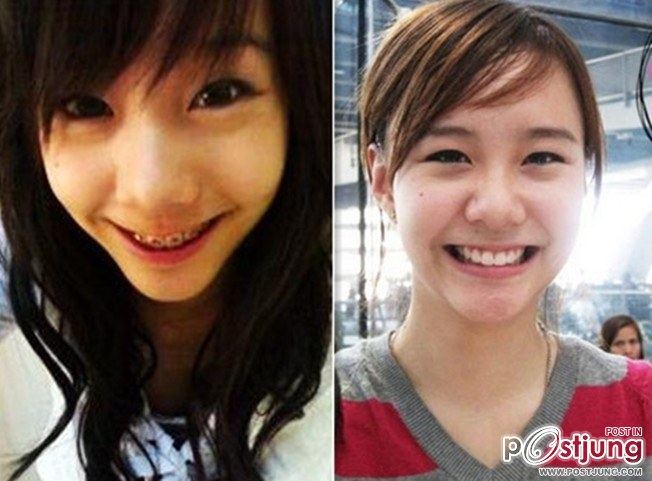 สาวๆก่อนและหลังดัดฟัน