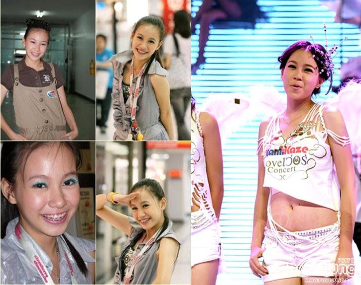 สาวๆก่อนและหลังดัดฟัน