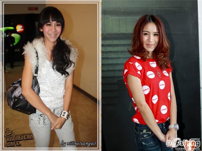สาวๆก่อนและหลังดัดฟัน