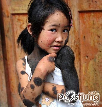 หนูน้อยคนนี้อาศัยอยู่ในจีน เธอถูกพ่อเเม่รังเกียจเพราะเป็นโรคประหลาด