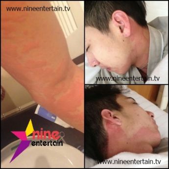 โตโน่ ลมพิษเฉียบพลันเข้ารักษาตัวโรงพยาบาลแล้ว