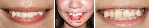 สึเคะ-ยาเอบะ เทรนด์ต่อฟันเขี้ยวที่มาแรงสุด ๆ ในญี่ปุ่น