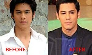 จมูกใหม่? เมาส์ ซี ศิวัตน์ ศัลกรรมจมูก หน้าดูคมขึ้น !!!