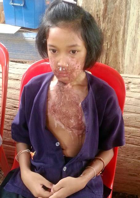 วอนคนใจบุญช่วยเด็กแฝดสุโขทัยถูกน้ำมันทอดไข่ลวกหน้า-อกสาหัส ทรมานร่วมปี