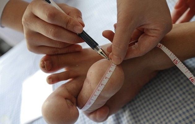Chinese teen with giant feet gets free treatment