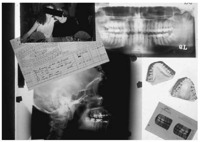 ภาพ x-ray ของศพ
