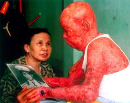 เหยื่อฝนเหลืองในเวียดนามผลพวงจากสงครามเวียดนาม
