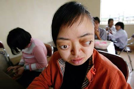 เหยื่อฝนเหลืองในเวียดนามผลพวงจากสงครามเวียดนาม