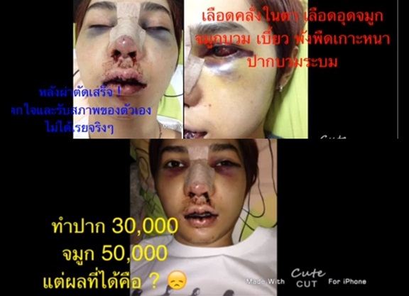หน้าพัง ศัลยกรรมเฉียดแสด จริงเหรอ!!!!!