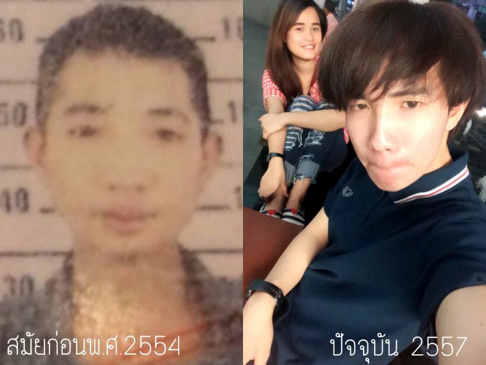 ศัลยกรรมแล้วดูดีมากๆ