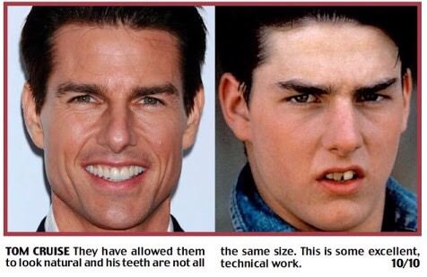ฟันสวยเปลี่ยนชีวิต...มาดู ดารา Hollywood ทำ Veneer กันเถอะ