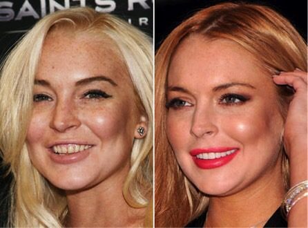 ฟันสวยเปลี่ยนชีวิต...มาดู ดารา Hollywood ทำ Veneer กันเถอะ
