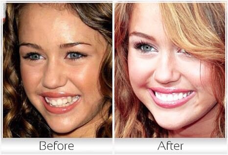 ฟันสวยเปลี่ยนชีวิต...มาดู ดารา Hollywood ทำ Veneer กันเถอะ