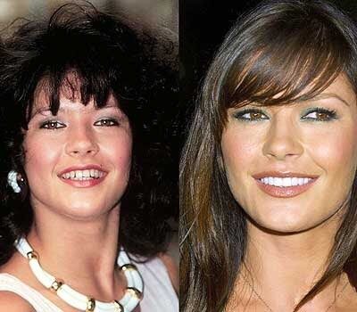 ฟันสวยเปลี่ยนชีวิต...มาดู ดารา Hollywood ทำ Veneer กันเถอะ
