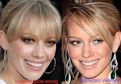 ฟันสวยเปลี่ยนชีวิต...มาดู ดารา Hollywood ทำ Veneer กันเถอะ