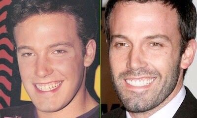 ฟันสวยเปลี่ยนชีวิต...มาดู ดารา Hollywood ทำ Veneer กันเถอะ