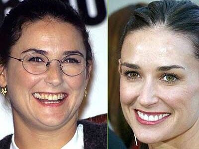 ฟันสวยเปลี่ยนชีวิต...มาดู ดารา Hollywood ทำ Veneer กันเถอะ