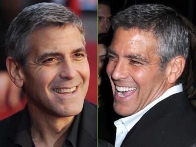 ฟันสวยเปลี่ยนชีวิต...มาดู ดารา Hollywood ทำ Veneer กันเถอะ