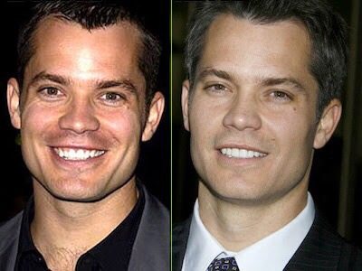 ฟันสวยเปลี่ยนชีวิต...มาดู ดารา Hollywood ทำ Veneer กันเถอะ