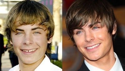ฟันสวยเปลี่ยนชีวิต...มาดู ดารา Hollywood ทำ Veneer กันเถอะ