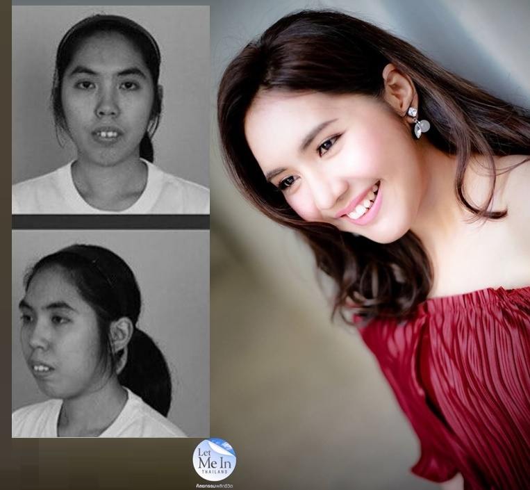 สวยจนตะลึง!!! "หลิน วงศ์ตะวัน" สาวศัลยกรรมพลิกชีวิต Let Me In Thailand คนแรกของประเทศไทย