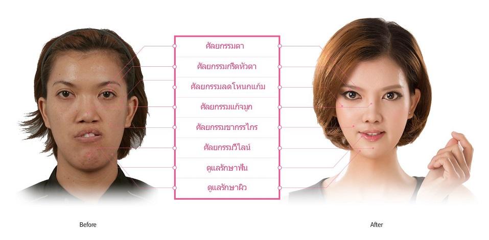 เอฟ วลีรัตน์ Let Me In Thailand โรงพยาบาลไอดี