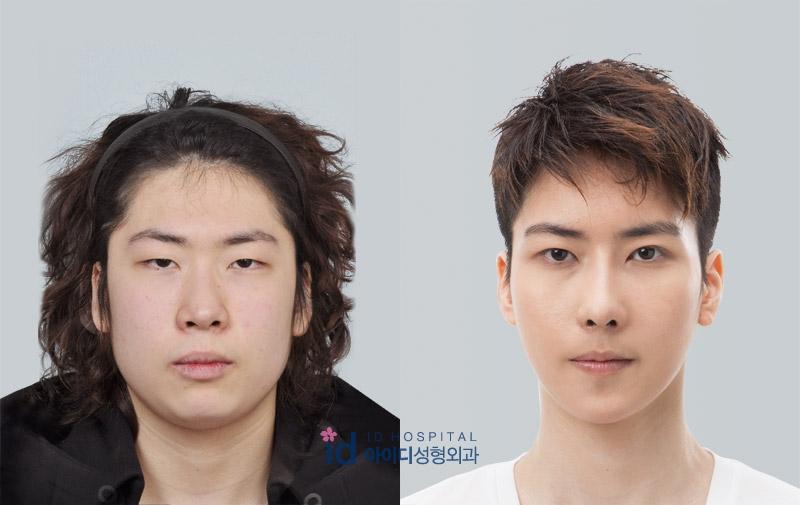 LET ME IN : โรงพยาบาลไอดี คุณหมอปาร์ค~amazing makeover!