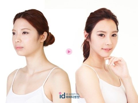 ดาราเกาหลี : ทำศัลยกรรมขากรรไกรปากยื่นที่ รพ.ไอดีเกาหลี