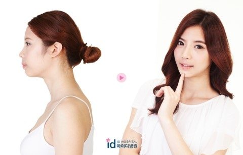 ดาราเกาหลี : ทำศัลยกรรมขากรรไกรปากยื่นที่ รพ.ไอดีเกาหลี