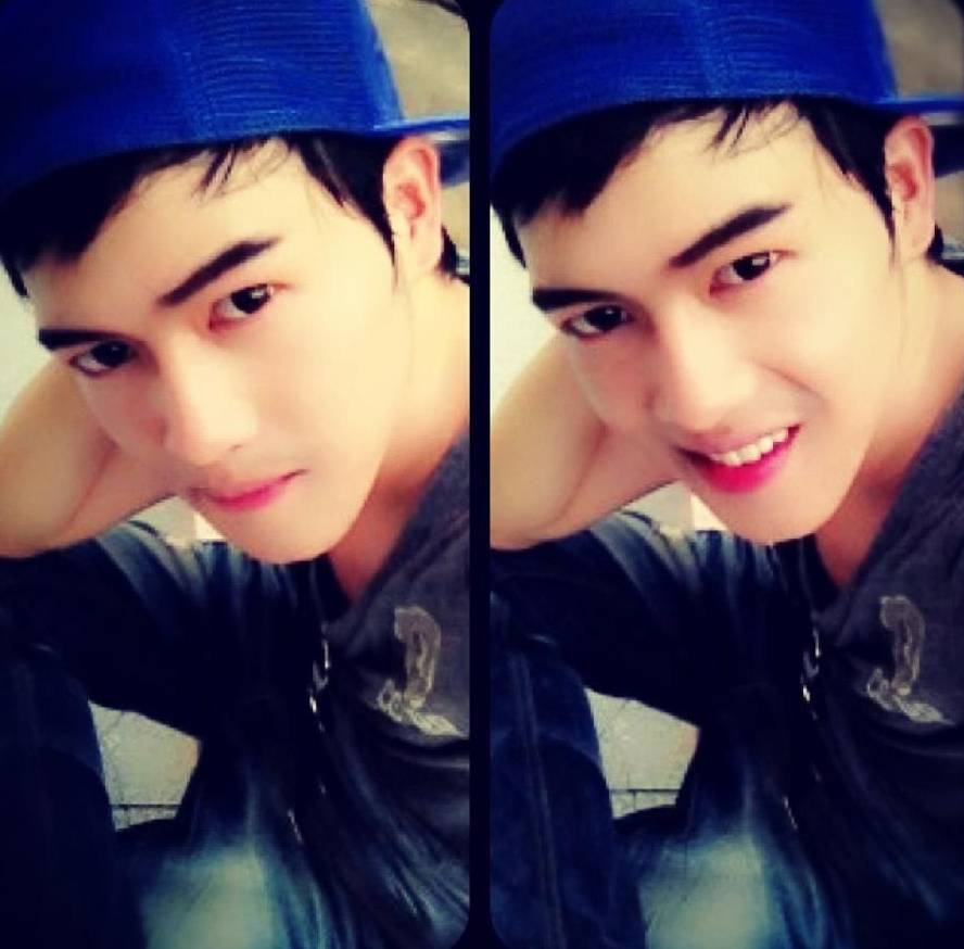 อาร์ม KPN ก่อนและหลังศัลยกรรม